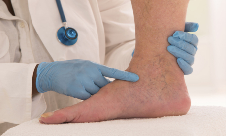 Varice în picioare: simptome și tratament - Motive