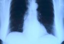 Nouă semne subtile care pot indica cancerul pulmonar